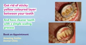 teeth scaling banner